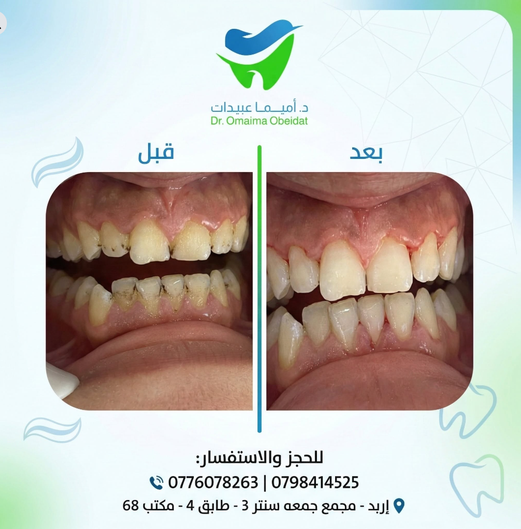 حالة تنظيف وتجميل قبل وبعد