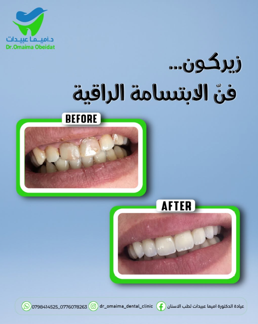 حالة فن الابتسامة الراقية قبل وبعد