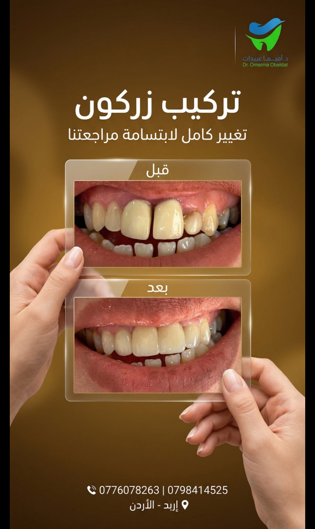 حالة تركيب زركون قبل وبعد