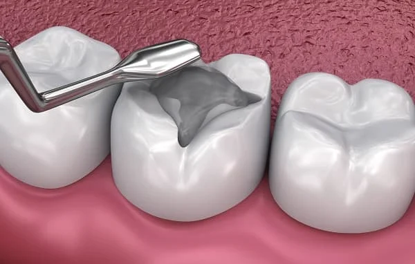 حشوة تجميلية بلون قريب من لون السن الطبيعي